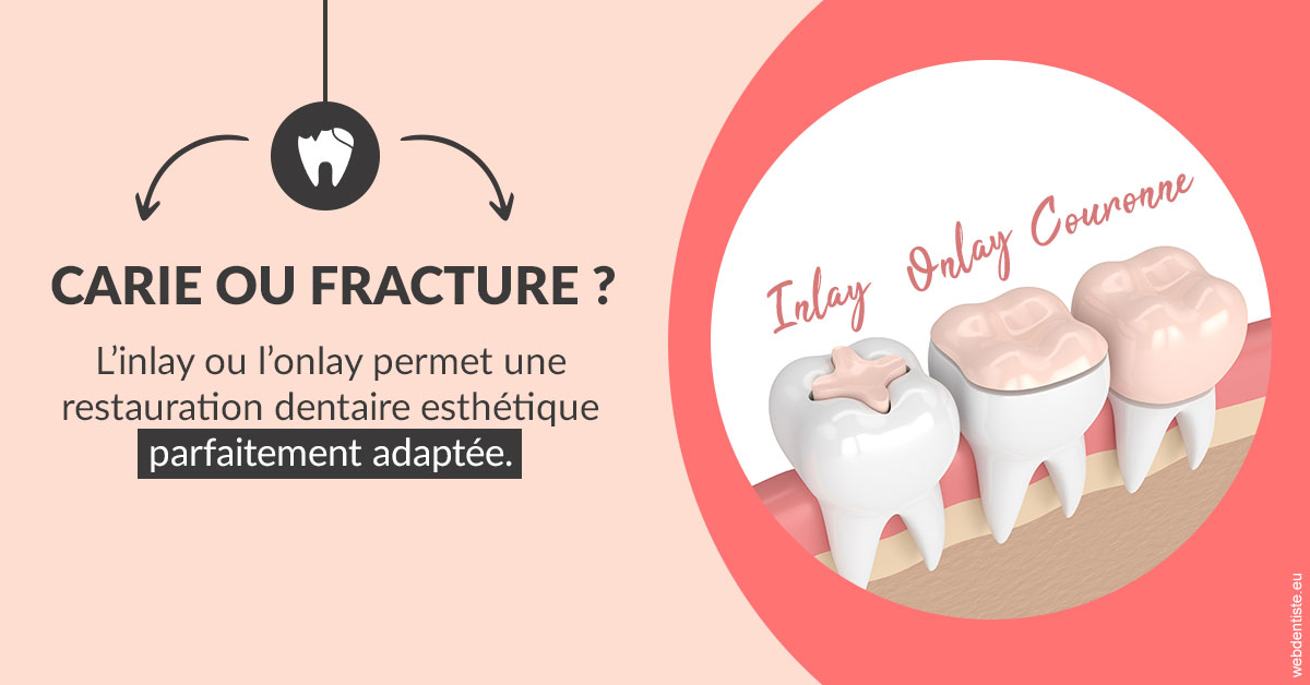 https://dr-tran-minh-hoa-cuc.chirurgiens-dentistes.fr/T2 2023 - Carie ou fracture 2