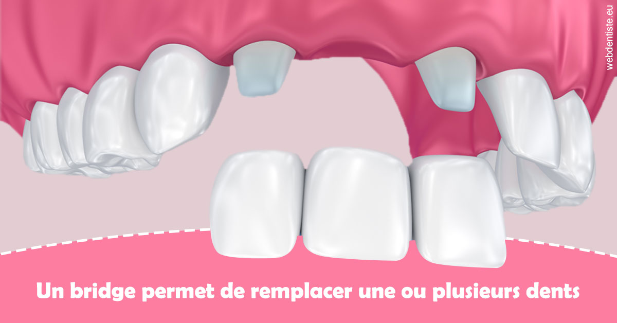 https://dr-tran-minh-hoa-cuc.chirurgiens-dentistes.fr/Bridge remplacer dents 2