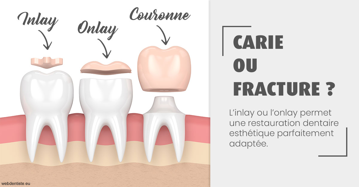 https://dr-tran-minh-hoa-cuc.chirurgiens-dentistes.fr/T2 2023 - Carie ou fracture 1