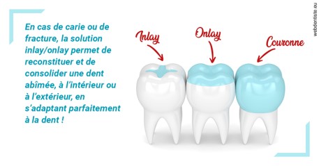 https://dr-tran-minh-hoa-cuc.chirurgiens-dentistes.fr/L'INLAY ou l'ONLAY