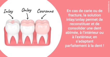 https://dr-tran-minh-hoa-cuc.chirurgiens-dentistes.fr/L'INLAY ou l'ONLAY 2
