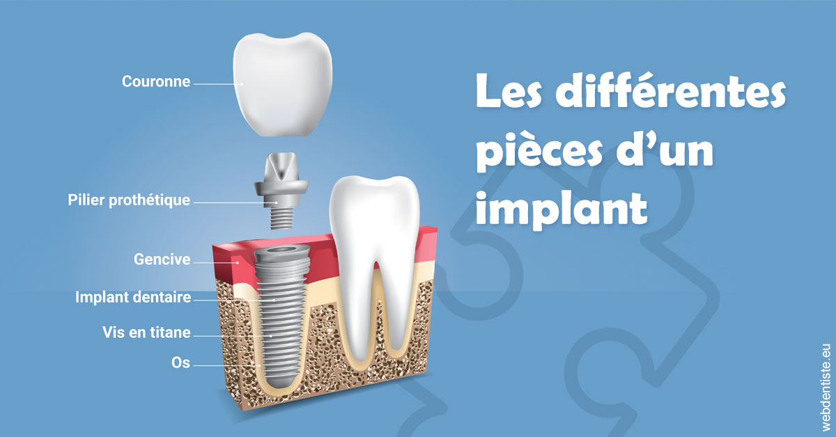 https://dr-tran-minh-hoa-cuc.chirurgiens-dentistes.fr/Les différentes pièces d’un implant 1